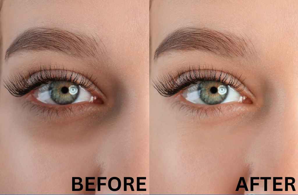 darkcircle treatment twacha aesthetic skin clinic