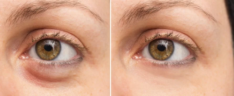 eyelid bag surgery